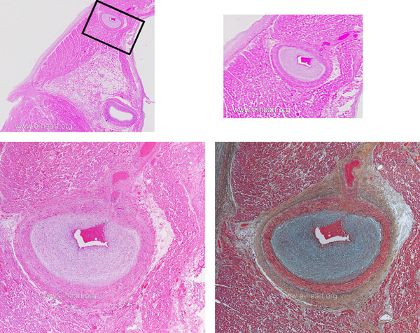 CAV in atrial artery